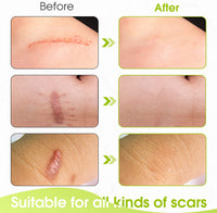 Thumbnail for Silicone Scar Sheets - LightsBetter